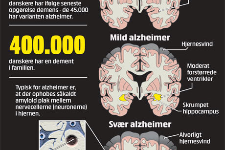 Fakta om Alzheimers